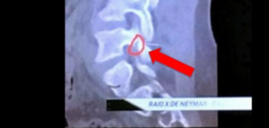 La frattura vertebrale di Neymar è un fake?