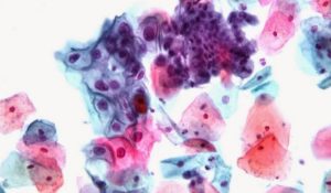 ESAME DELLE URINE SOSTITUIRÀ IL PAP TEST?