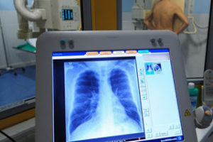 Tumore del polmone, crizotinib approvato in Europa anche come prima linea