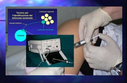 Biopsia del linfonodo sentinella per melanoma: una tecnica che può salvarti la vita